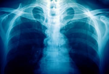 Konsultacje pulmonologiczne Konsultacje pulmonologiczne